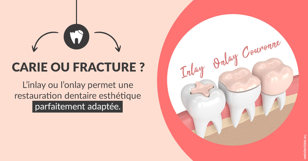 https://dr-treil-bruno.chirurgiens-dentistes.fr/T2 2023 - Carie ou fracture 2