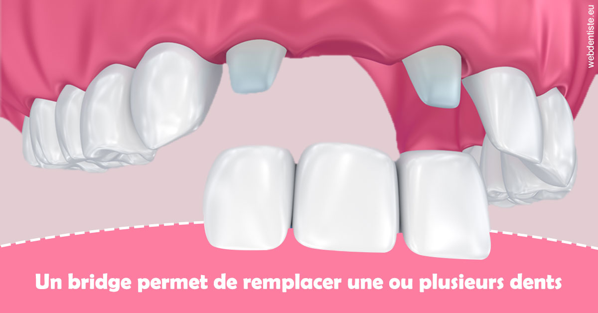 https://dr-treil-bruno.chirurgiens-dentistes.fr/Bridge remplacer dents 2