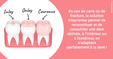 https://dr-treil-bruno.chirurgiens-dentistes.fr/L'INLAY ou l'ONLAY 2