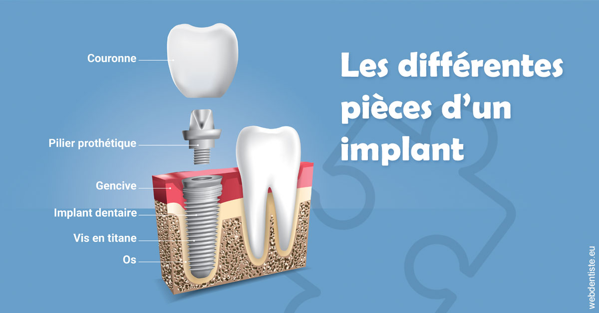 https://dr-treil-bruno.chirurgiens-dentistes.fr/Les différentes pièces d’un implant 1